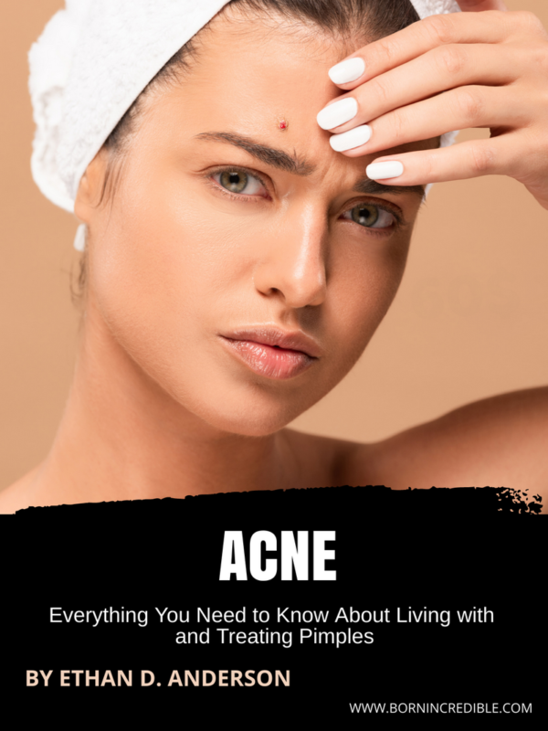 Acne: Everything You Need to Know About Living with and Treating Pimples